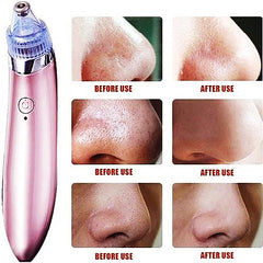 Máquina Sucção A Vácuo Remove Cravo Aparelho Acne Rosa